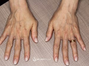 【50代女性・ハリのある若々しい手の甲】プレミアムPRP皮膚再生療法（術後2年） Before 