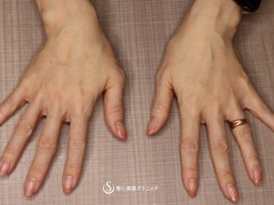 【50代女性・ハリのある若々しい手の甲】プレミアムPRP皮膚再生療法（術後2年） After 