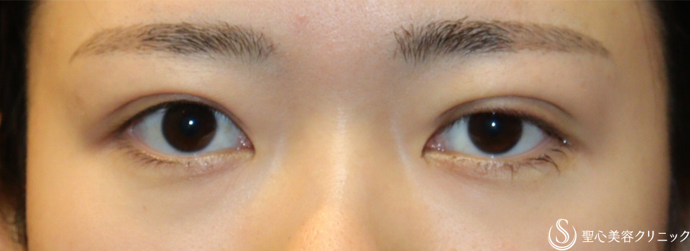 【20代女性・左右差を無くしたい】二重術埋没法（マイクロメソッド＋α）（1ヶ月後） After 