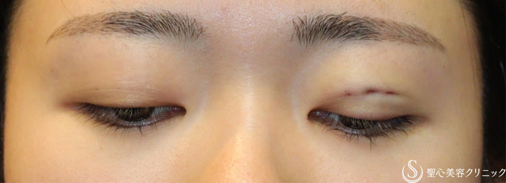 【20代女性・左右差を無くしたい】二重術埋没法（マイクロメソッド＋α）（1ヶ月後） After 