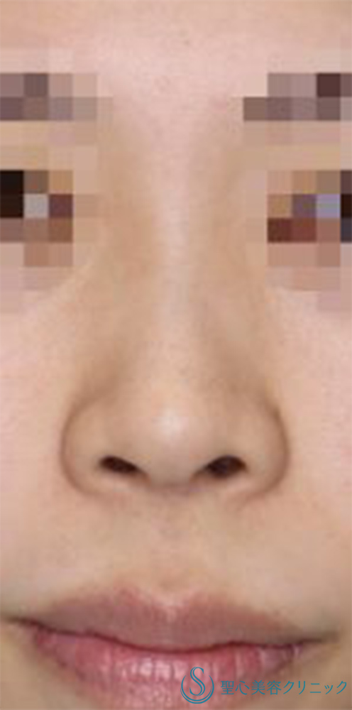 【20代女性・周りにバレない程度で鼻をナチュラルにバランス良くスッキリ！！】鼻尖縮小＋鼻尖形成（耳介軟骨移植・ストラット法）＋Gメッシュ（5本）（術後1ヶ月） Before 