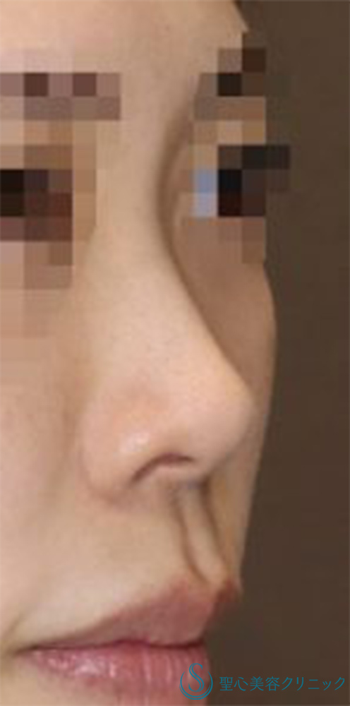 【20代女性・周りにバレない程度で鼻をナチュラルにバランス良くスッキリ！！】鼻尖縮小＋鼻尖形成（耳介軟骨移植・ストラット法）＋Gメッシュ（5本）（術後1ヶ月） Before 