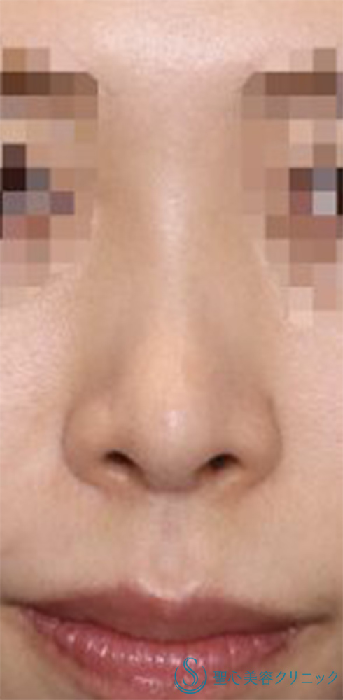 【20代女性・周りにバレない程度で鼻をナチュラルにバランス良くスッキリ！！】鼻尖縮小＋鼻尖形成（耳介軟骨移植・ストラット法）＋Gメッシュ（5本）（術後1ヶ月） After 
