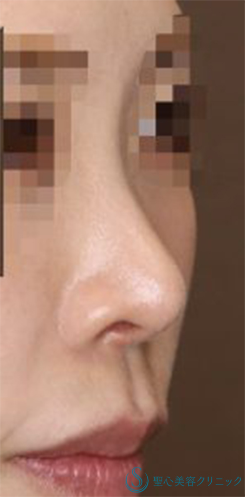 【20代女性・周りにバレない程度で鼻をナチュラルにバランス良くスッキリ！！】鼻尖縮小＋鼻尖形成（耳介軟骨移植・ストラット法）＋Gメッシュ（5本）（術後1ヶ月） After 