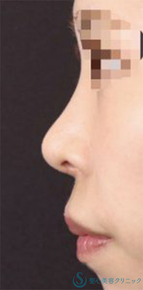 【20代女性・周りにバレない程度で鼻をナチュラルにバランス良くスッキリ！！】鼻尖縮小＋鼻尖形成（耳介軟骨移植・ストラット法）＋Gメッシュ（5本）（術後1ヶ月） After 