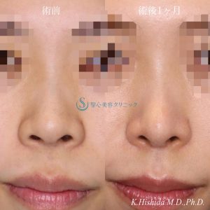 【20代女性・周りにバレない程度で鼻をナチュラルにバランス良くスッキリ！！】鼻尖縮小＋鼻尖形成（耳介軟骨移植・ストラット法）＋Gメッシュ（5本）（術後1ヶ月） After 
