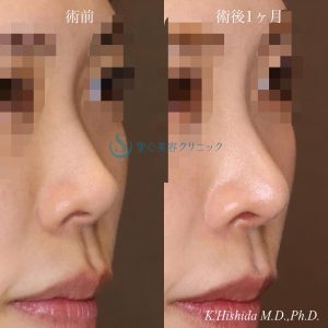 【20代女性・周りにバレない程度で鼻をナチュラルにバランス良くスッキリ！！】鼻尖縮小＋鼻尖形成（耳介軟骨移植・ストラット法）＋Gメッシュ（5本）（術後1ヶ月） After 