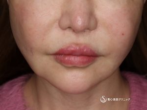 【60代女性・綺麗にマリオネットラインが目立たなく】フェイスリフト（術後1ヶ月） Before 