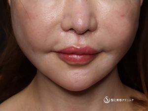 【60代女性・綺麗にマリオネットラインが目立たなく】フェイスリフト（術後1ヶ月） After 