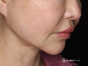 【60代女性・綺麗にマリオネットラインが目立たなく】フェイスリフト（術後1ヶ月） Before 