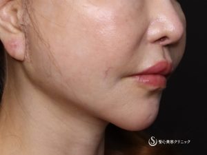 【60代女性・綺麗にマリオネットラインが目立たなく】フェイスリフト（術後1ヶ月） After 