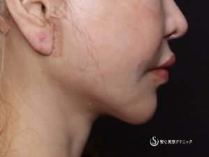 【60代女性・綺麗にマリオネットラインが目立たなく】フェイスリフト（術後1ヶ月） After 