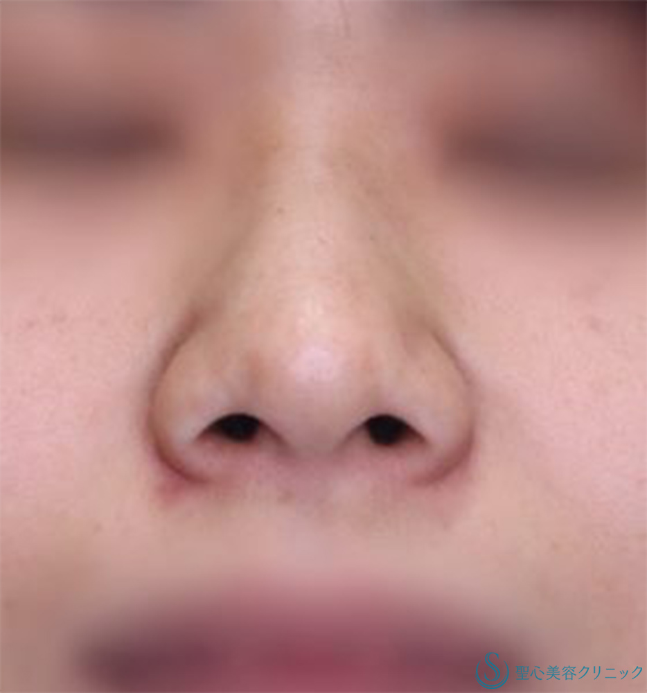 【30代女性・小鼻の広がりをスッキリ】小鼻縮小（術後1年） Before 