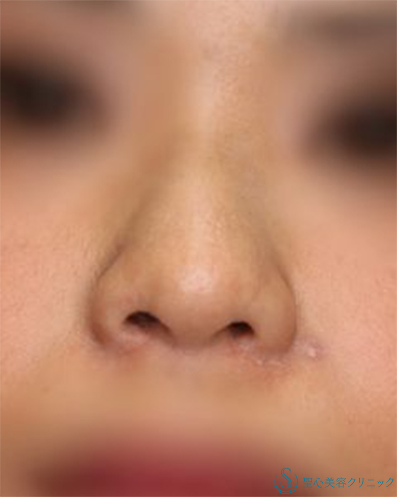 【30代女性・小鼻の広がりをスッキリ】小鼻縮小（術後1年） After 