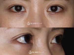 【30代女性・自然かつしっかりと変化】たれ目形成（グラマラスライン／下眼瞼下制術）（術後1ヶ月） After 