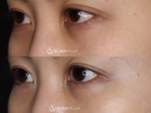 【30代女性・自然かつしっかりと変化】たれ目形成（グラマラスライン／下眼瞼下制術）（術後1ヶ月） After 