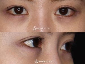 【30代女性・自然かつしっかりと変化】たれ目形成（グラマラスライン／下眼瞼下制術）（術後1ヶ月） After 