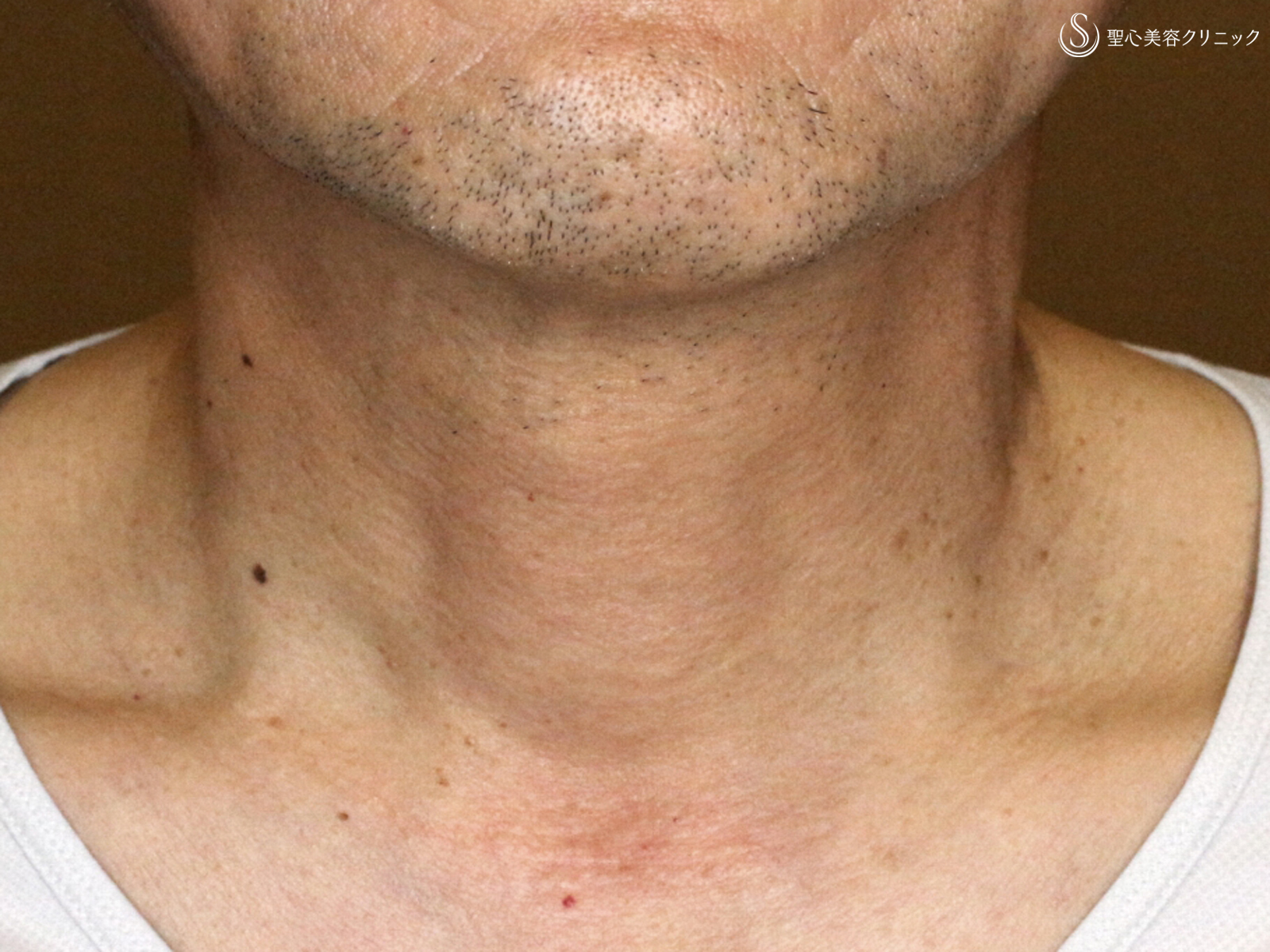 【50代男性・首の横じわは難しい】プレミアムPRP皮膚再生療法 単独（6年後） After 