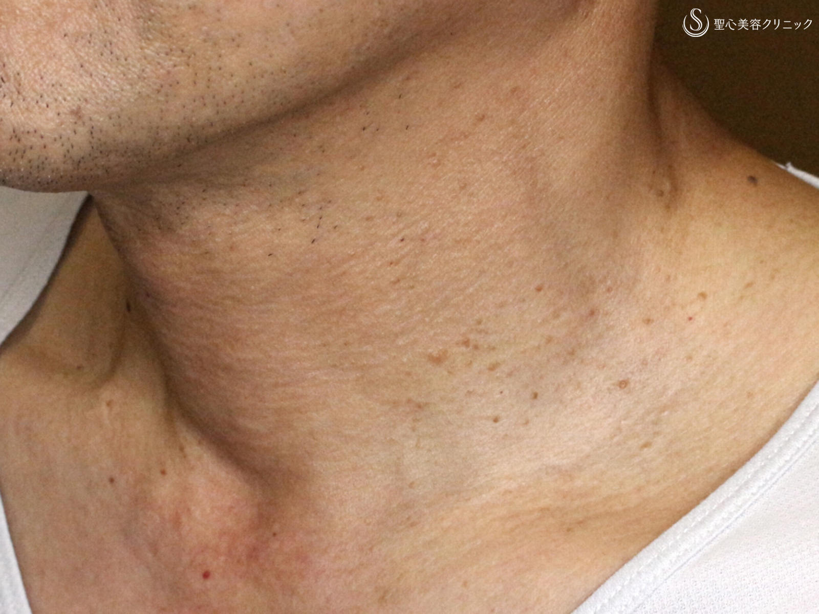 【50代男性・首の横じわは難しい】プレミアムPRP皮膚再生療法 単独（6年後） After 