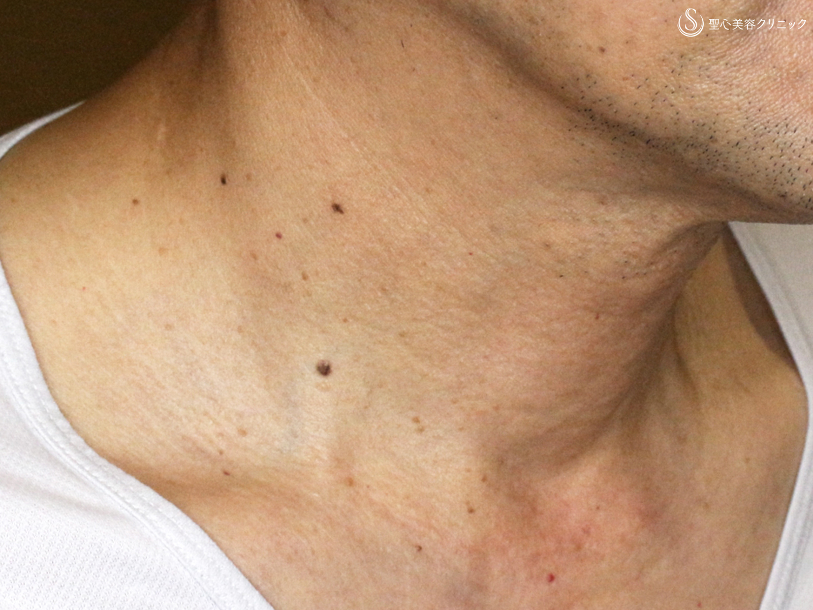 【50代男性・首の横じわは難しい】プレミアムPRP皮膚再生療法 単独（6年後） After 
