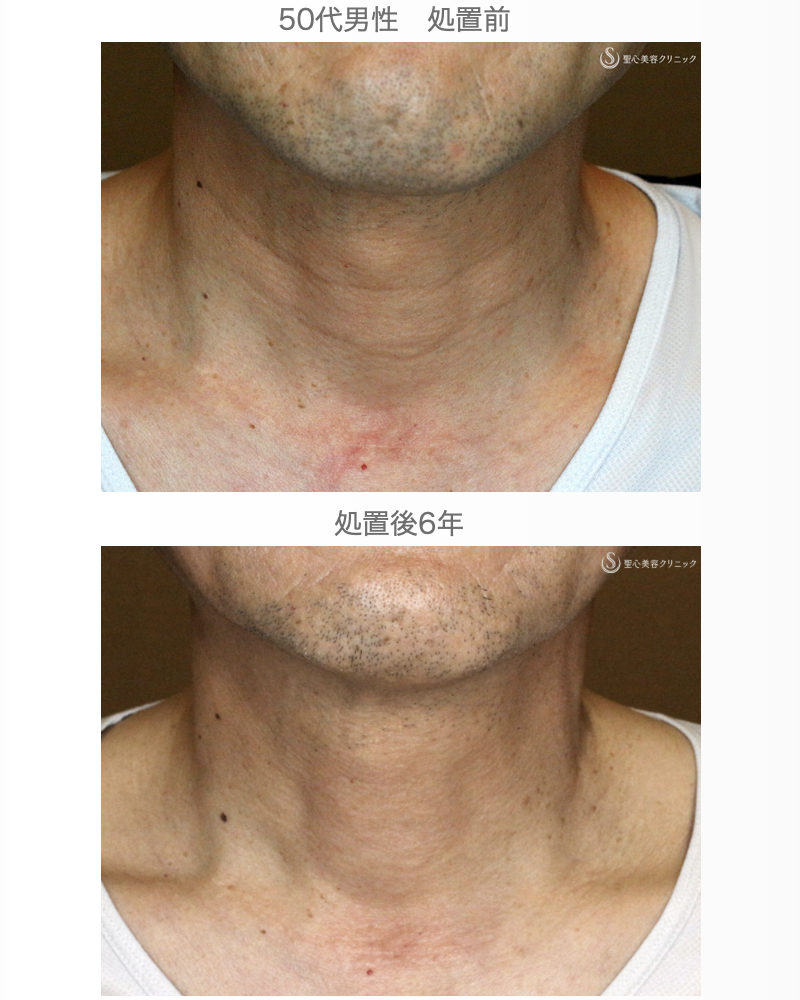【50代男性・首の横じわは難しい】プレミアムPRP皮膚再生療法 単独（6年後） After 