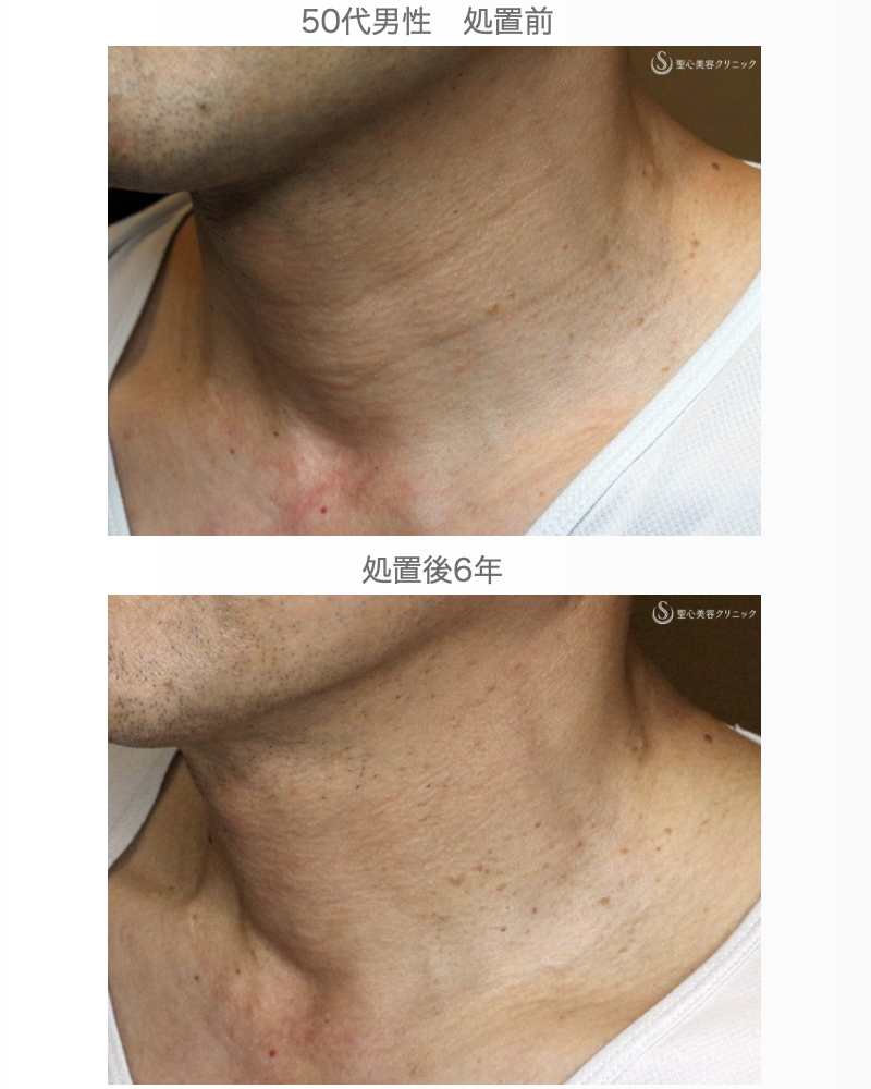 【50代男性・首の横じわは難しい】プレミアムPRP皮膚再生療法 単独（6年後） After 