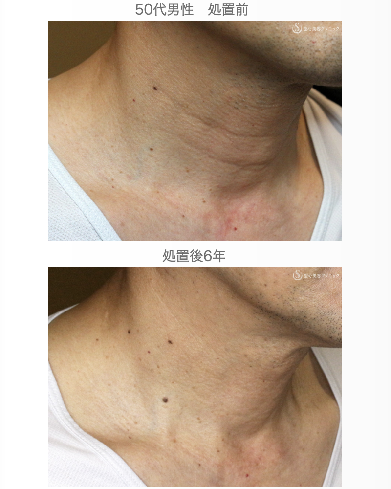 【50代男性・首の横じわは難しい】プレミアムPRP皮膚再生療法 単独（6年後） After 