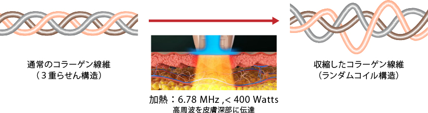 ドクターDENSITYのメカニズム