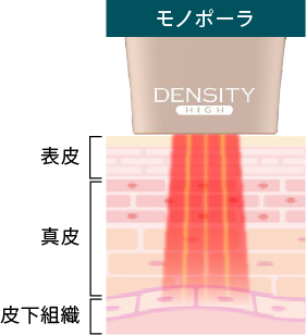 モノポーラRF