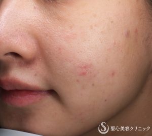 【20代女性・凹んだ傷跡治療】ピコレーザー（PICOフラクショナル）（2回施術後） After 