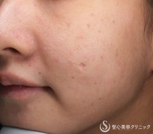 【20代女性・凹んだ傷跡治療】ピコレーザー（PICOフラクショナル）（2回施術後） Before 