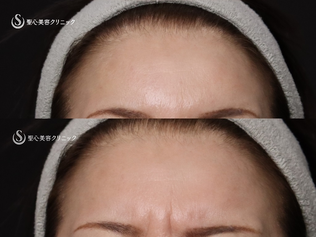 【60代女性・額と眉間をふっくらと】 プレミアムPRP皮膚再生療法（5か月後） After 