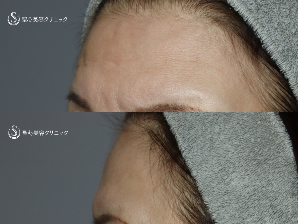 【60代女性・額と眉間をふっくらと】 プレミアムPRP皮膚再生療法（5か月後） Before 