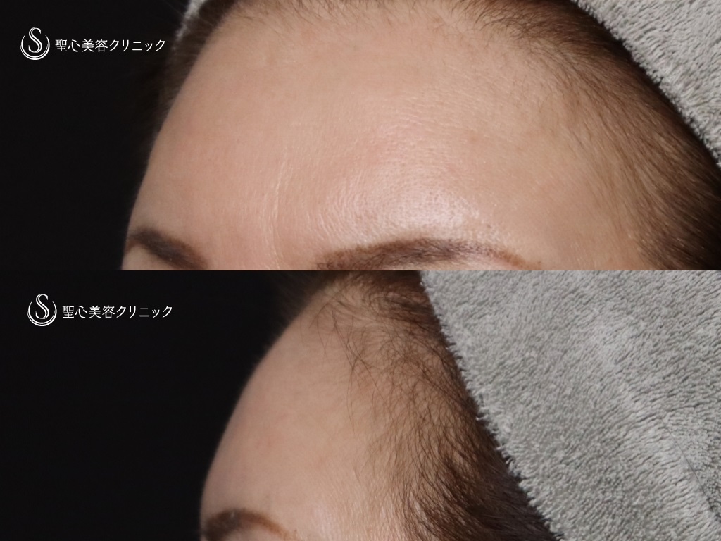 【60代女性・額と眉間をふっくらと】 プレミアムPRP皮膚再生療法（5か月後） After 