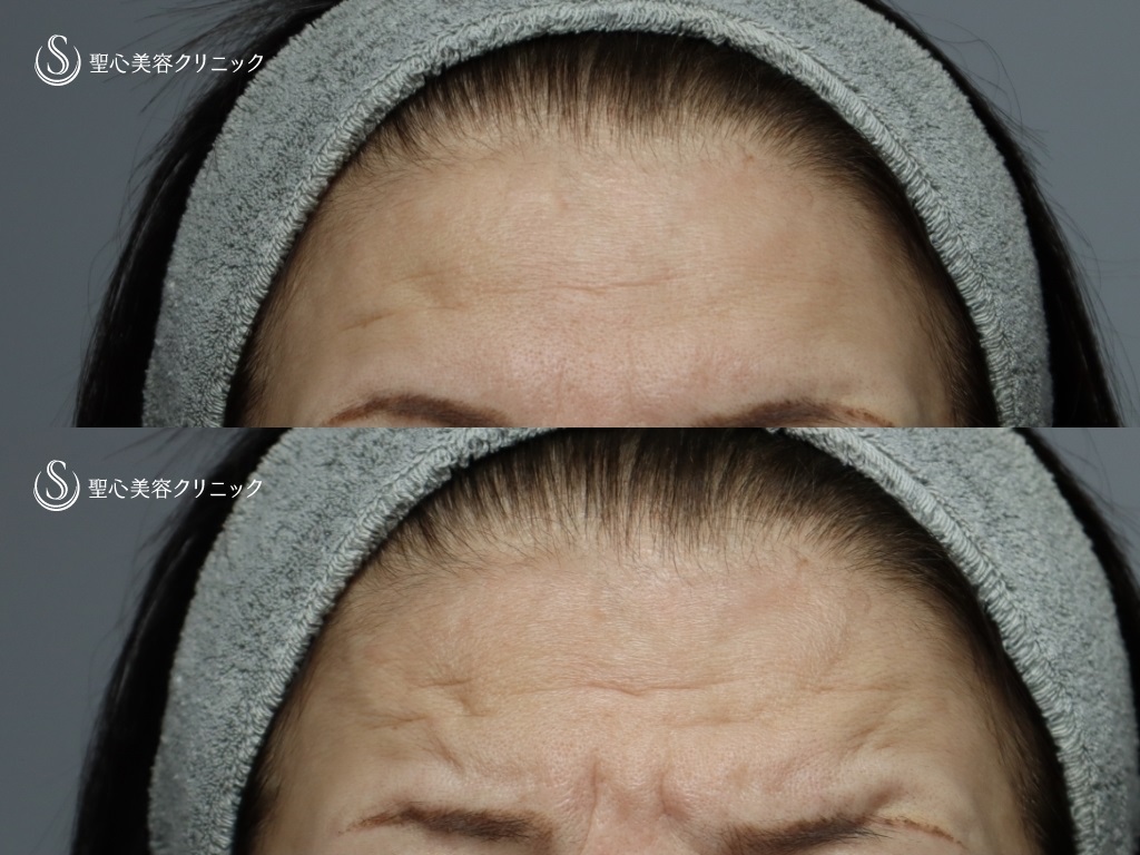 【60代女性・額と眉間をふっくらと】 プレミアムPRP皮膚再生療法（5か月後） Before 