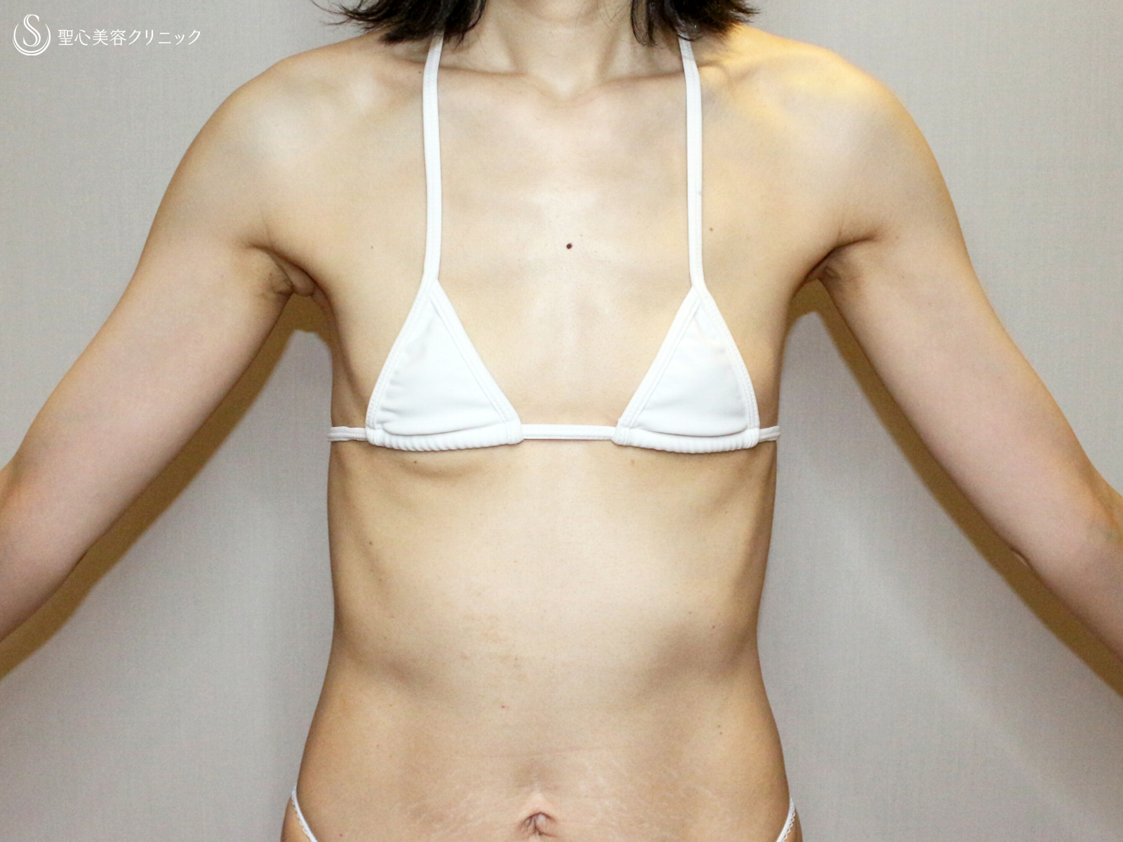 【39歳女性・脂肪幹細胞豊胸】プレミアムセリューション豊胸術（7ヶ月後） Before 