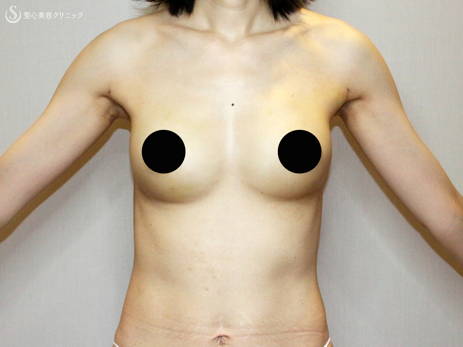 【39歳女性・脂肪幹細胞豊胸】プレミアムセリューション豊胸術（7ヶ月後） Before 