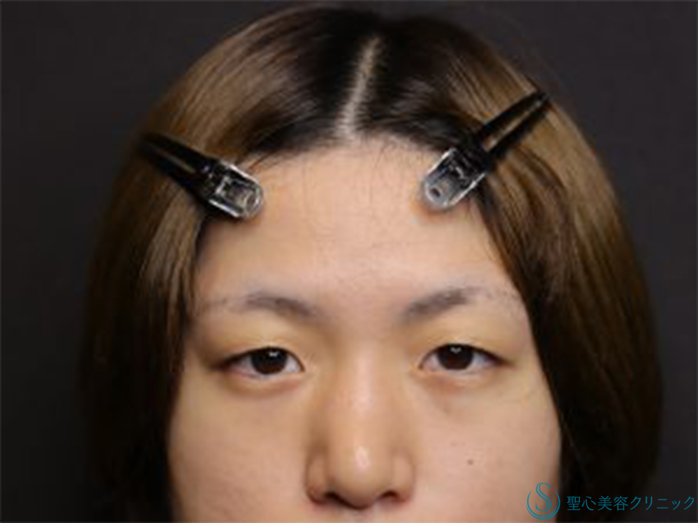 【20代女性・目元にナチュラルな立体感を】二重埋没法（マイクロメゾット＋α）＋涙袋ヒアルロン酸注入（術後1ヶ月） Before 