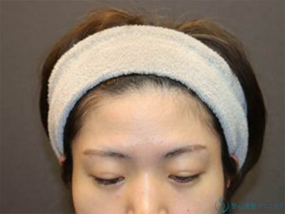 【20代女性・目元にナチュラルな立体感を】二重埋没法（マイクロメゾット＋α）＋涙袋ヒアルロン酸注入（術後1ヶ月） After 