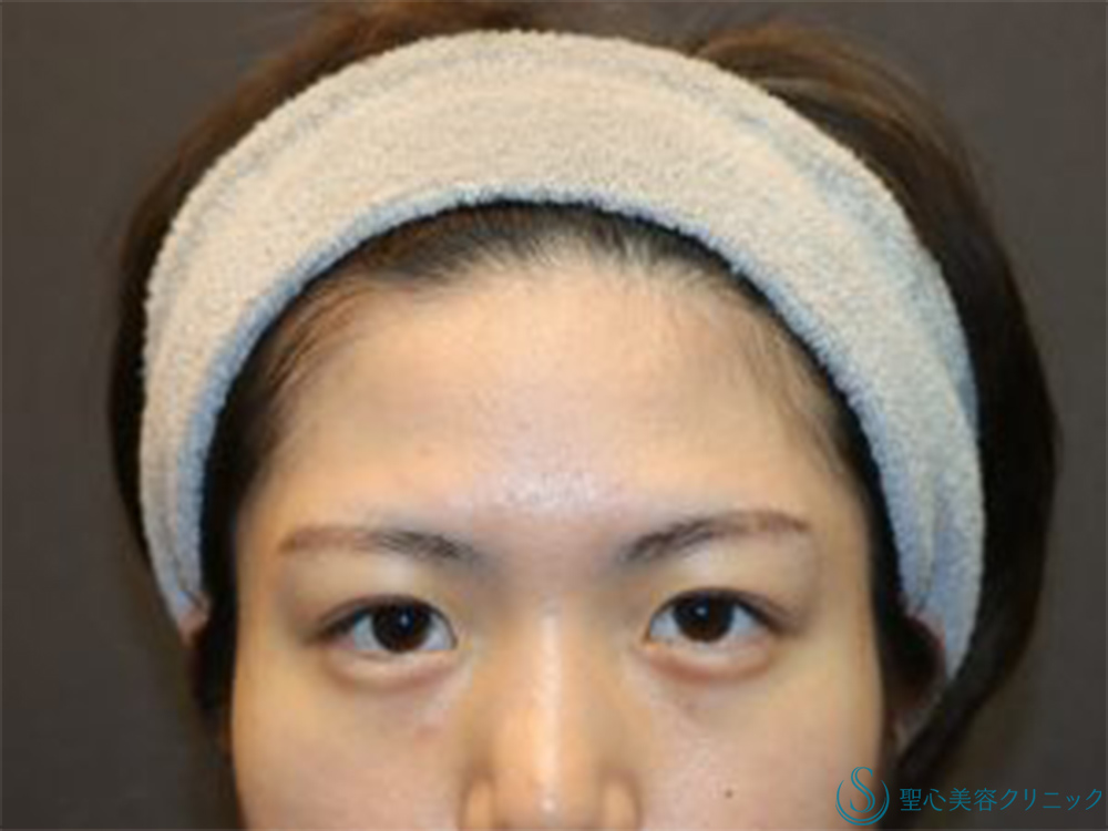 【20代女性・目元にナチュラルな立体感を】二重埋没法（マイクロメゾット＋α）＋涙袋ヒアルロン酸注入（術後1ヶ月） After 
