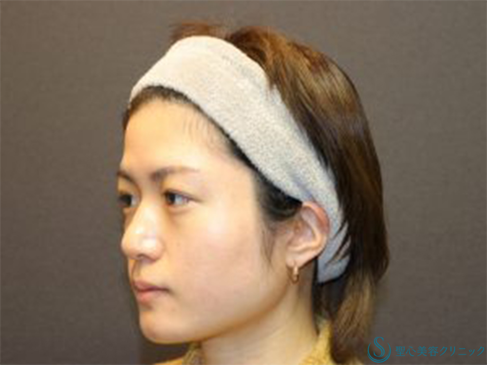 【20代女性・目元にナチュラルな立体感を】二重埋没法（マイクロメゾット＋α）＋涙袋ヒアルロン酸注入（術後1ヶ月） After 