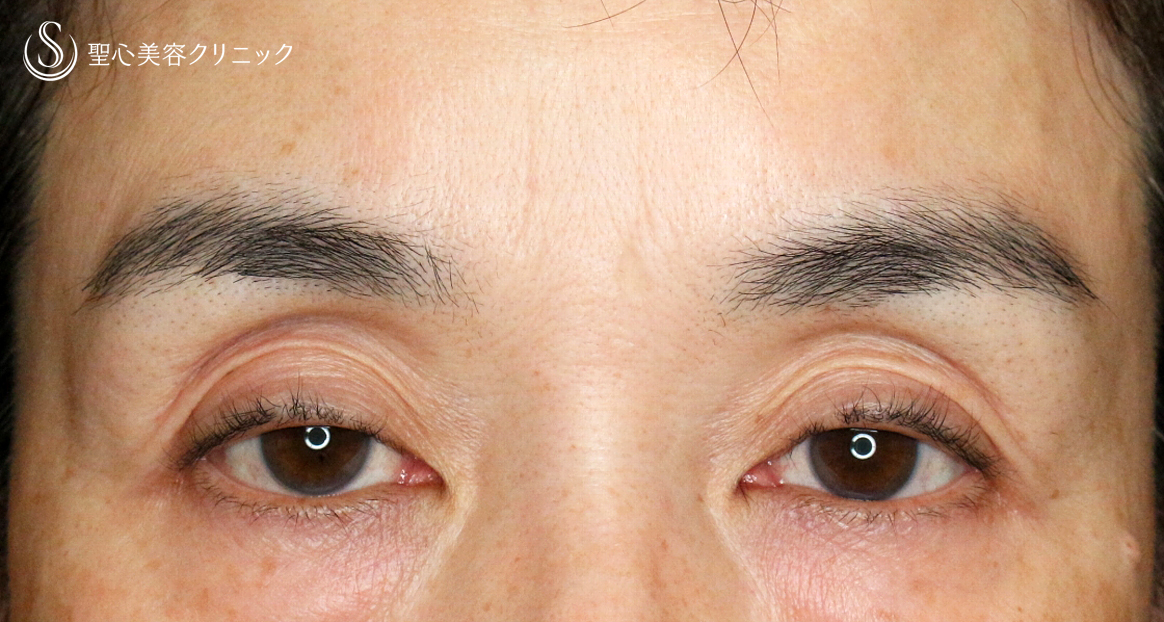 【50代女性・コンタクトレンズ眼瞼下垂】切らない眼瞼下垂+α法（術直後〜1年6ヶ月後） Before 