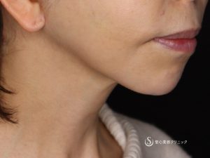 【50代女性・綺麗なフェイスラインに】ネックリフト（アゴ下）（術後1ヶ月） After 
