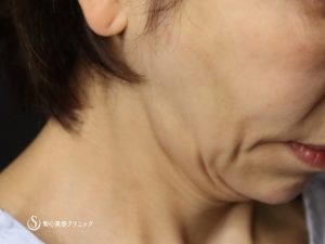 【50代女性・綺麗なフェイスラインに】ネックリフト（アゴ下）（術後1ヶ月） Before 