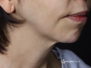 【50代女性・綺麗なフェイスラインに】ネックリフト（アゴ下）（術後1ヶ月） Before 