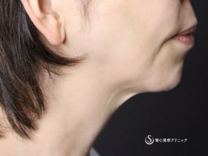 【50代女性・綺麗なフェイスラインに】ネックリフト（アゴ下）（術後1ヶ月） Before 