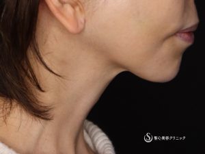 【50代女性・綺麗なフェイスラインに】ネックリフト（アゴ下）（術後1ヶ月） After 