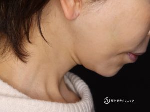 【50代女性・綺麗なフェイスラインに】ネックリフト（アゴ下）（術後1ヶ月） After 