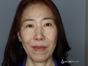 【50代女性・頬のたるみやフェイスラインがスッキリ】フェイスリフト（術後4ヶ月） Before 
