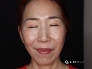 【50代女性・頬のたるみやフェイスラインがスッキリ】フェイスリフト（術後4ヶ月） After 